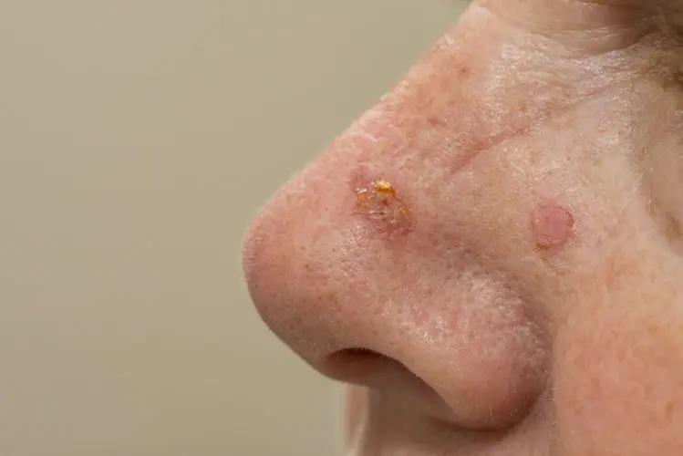 Phytochemical and Ayurvedic perspectives in skin cancer therapy